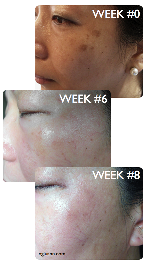 Try Obagi Toning for cure for Melasma